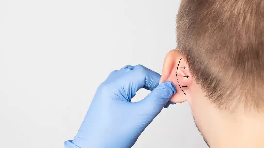 Kepçe Kulak Estetiği Ameliyatı