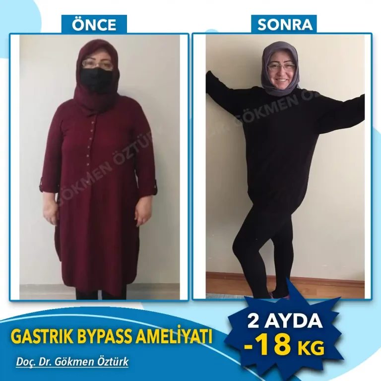 Gastric ByPass